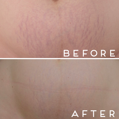 Decalys Medical La Pommade - Scar Remodeling & Prevention 30ml N2