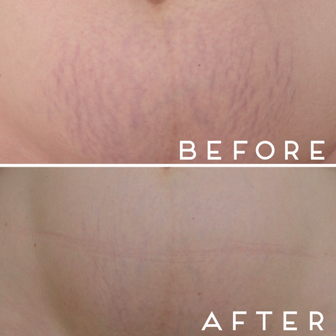 Decalys Medical La Pommade - Scar Remodeling & Prevention 30ml N2