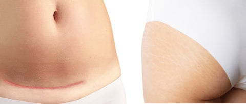 Decalys Medical La Pommade - Scar Remodeling & Prevention 30ml N2