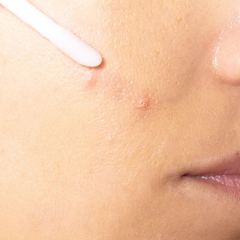 Soin clear anti-imperfections